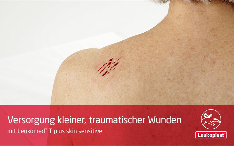 In diesem Video zeigen wir Ihnen, wie Sie Einrisse der Haut bei älteren Patienten vermeiden können: Das Fachpersonal behandelt die Schürfwunde einer älteren Patienten mit Leukomed® T plus skin sensitive. In diesem Video zeigen wir Ihnen, wie Sie Einrisse der Haut bei älteren Patienten vermeiden können: Das Fachpersonal behandelt die Schürfwunde einer älteren Patienten mit Leukomed® T plus skin sensitive.
